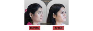 Eyebrow Transplant Cost in India – Expert Guide by Satya Hair Solution