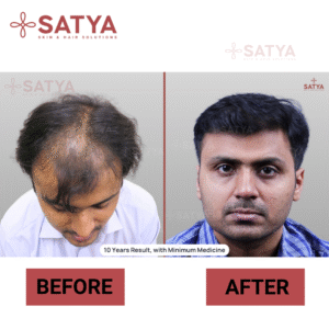 FUE Hair Transplant Cost India