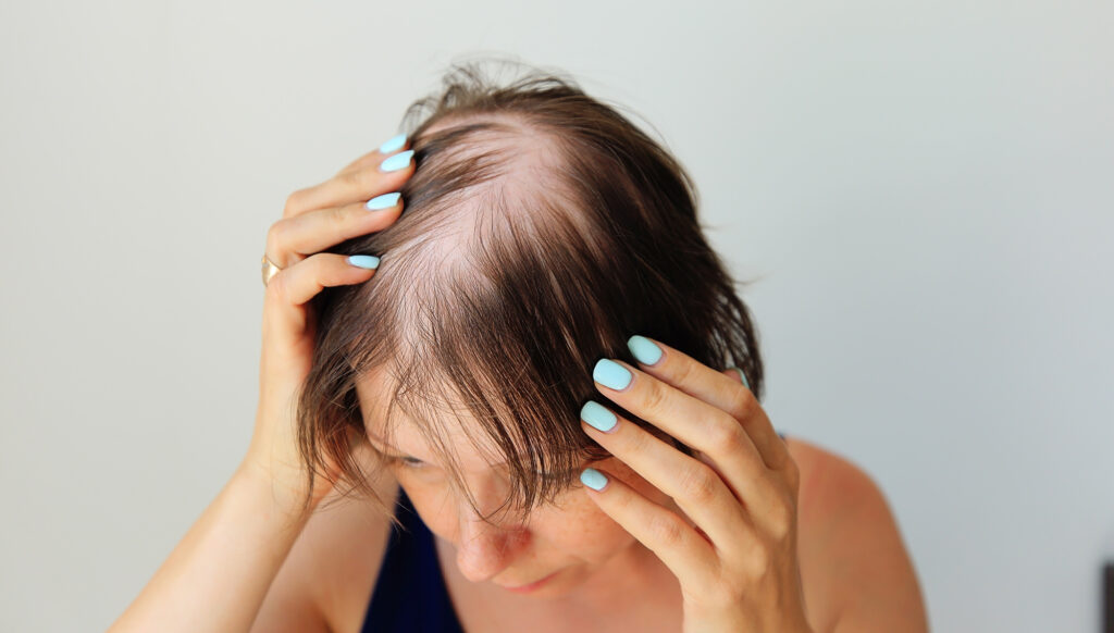 Female Hair Loss