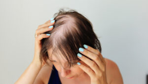 Female Hair Loss