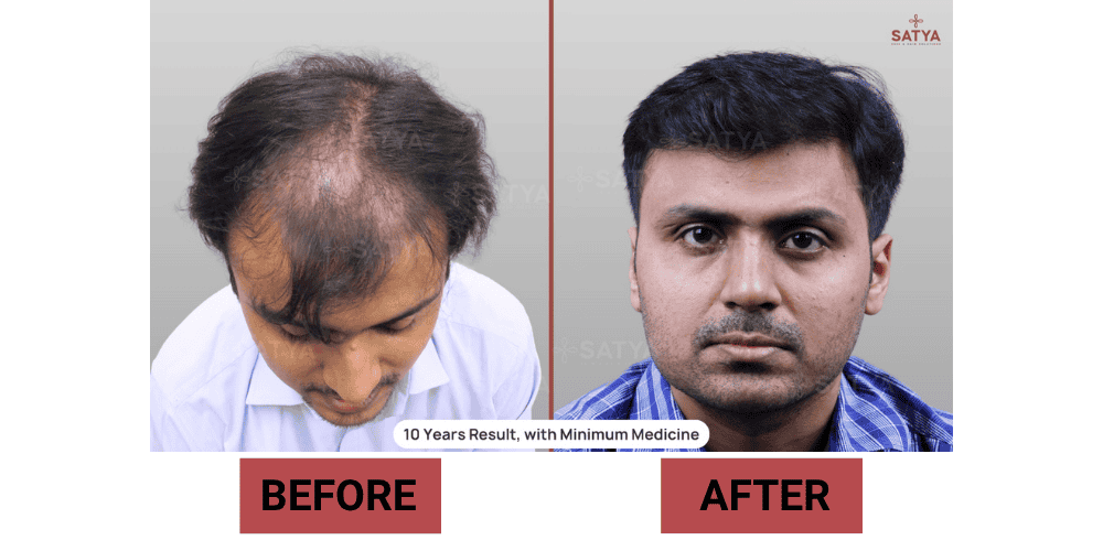 Hair Transplant Cost Per Graft in India