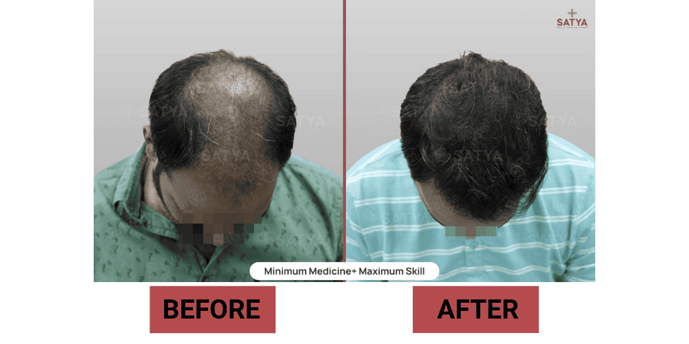 FUE vs FUT Hair Transplant