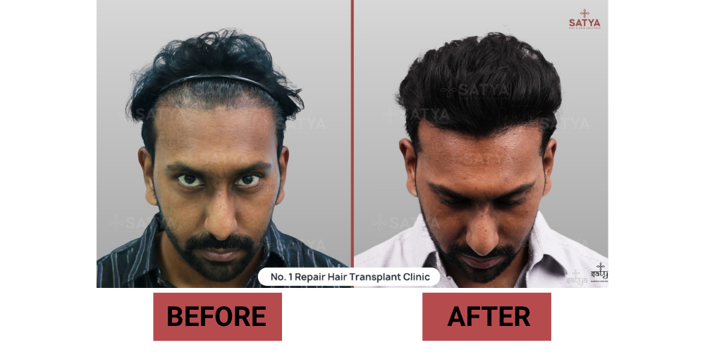 Repair Hair Transplant