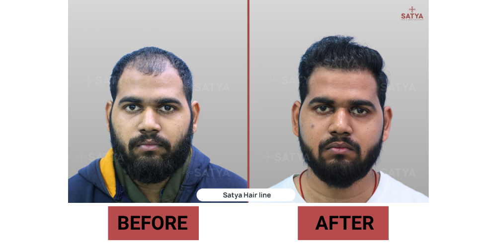 FUE Hair Transplant Cost in India