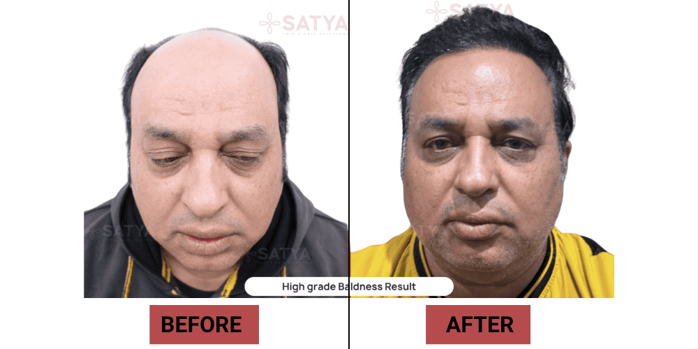 Hair Transplant Cost India