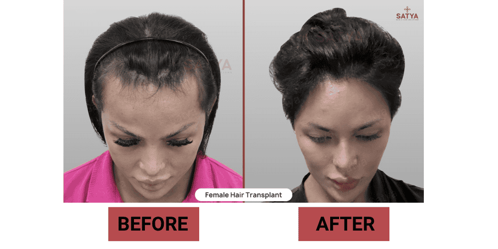 Female Hair Transplant in India