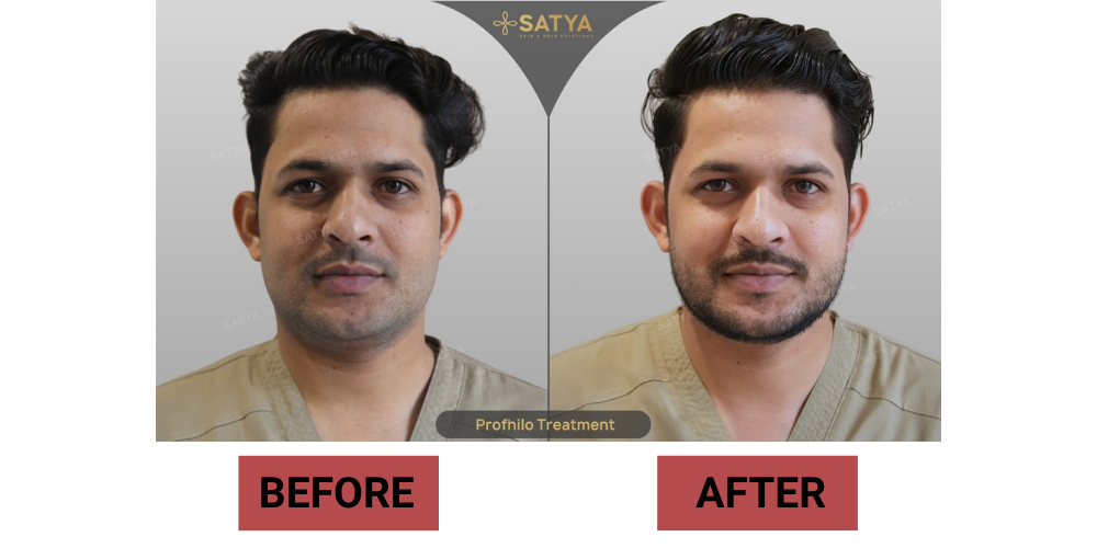 Beard Transplant Cost in Delhi