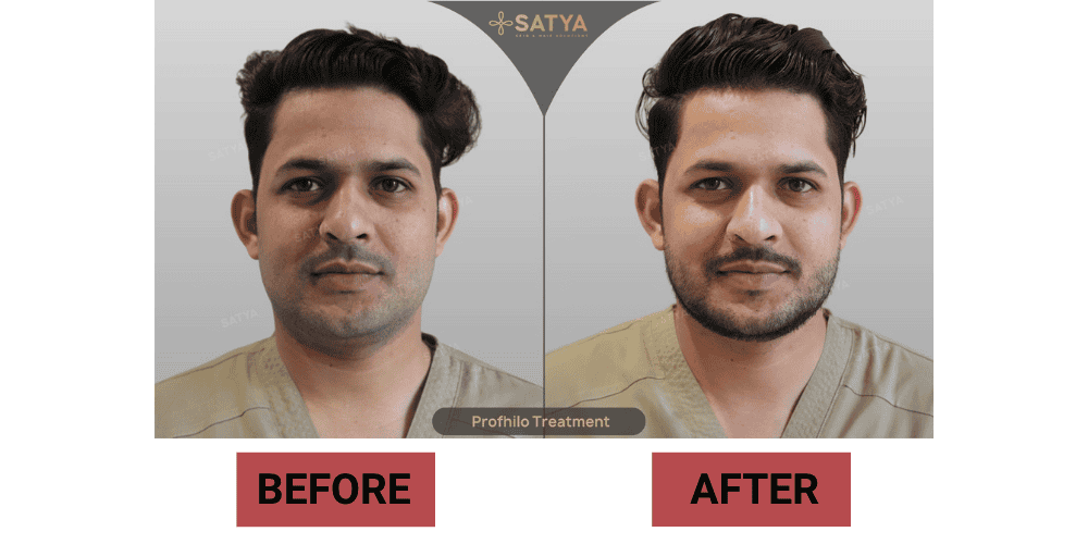 Beard Transplant Cost in Delhi