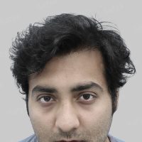 wrong hair transplant