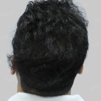 fue hair transplant