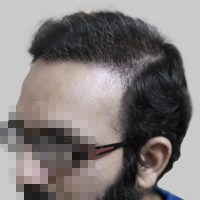 synthetic hair implant