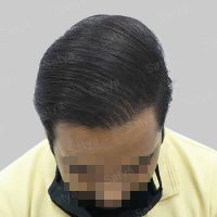 corrective hair transplant