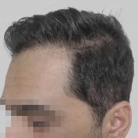 artificial hair transplant