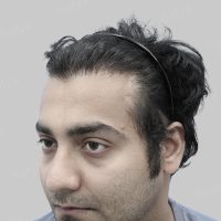 wrong hair transplant