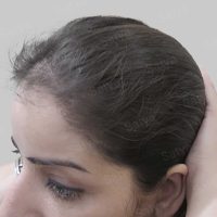 female hair transplant
