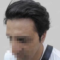 wrong hair line repair