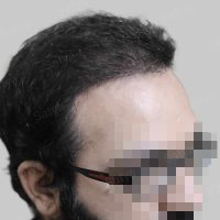 synthetic hair implant