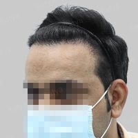 repair hair transplant result