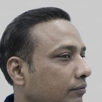 repair hair transplant