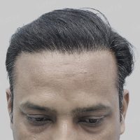 repair hair transplant