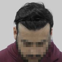hair transplant