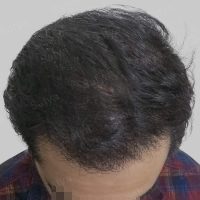 artificial hair implant