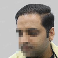 corrective hair transplant