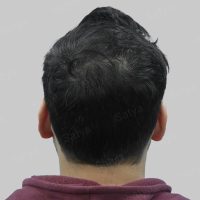 hair transplant