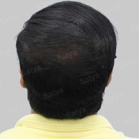 corrective hair transplant