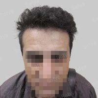 wrong hair line repair