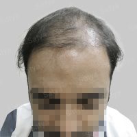 corrective hair transplant