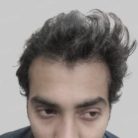 wrong hair transplant