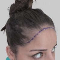 female hair transplant