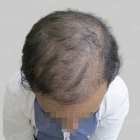 corrective hair transplant