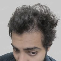 wrong hair transplant