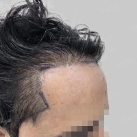 repair hair transplant result