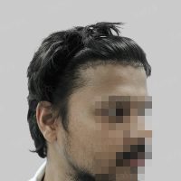 repair hair transplant