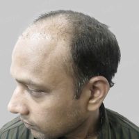 repair hair transplant