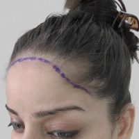 female hair transplant