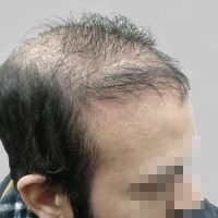 synthetic hair implant