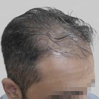 artificial hair transplant
