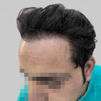 repair hair transplant result