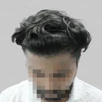 repair hair transplant