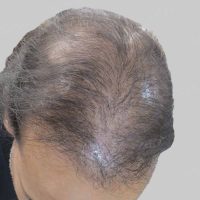 repair hair transplant