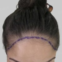 female hair transplant