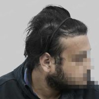 hair transplant