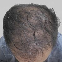 artificial hair transplant