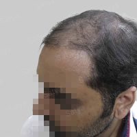 corrective hair transplant