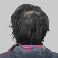 hair transplant