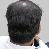 corrective hair transplant